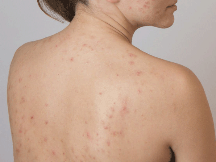 Làm gì để giảm mụn lưng? Chăm sóc da lưng sao cho đúng cách